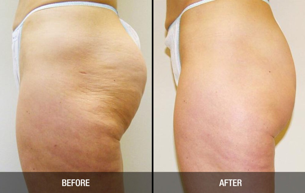 How Much Does Cellulite Reduction Treatment Cost?